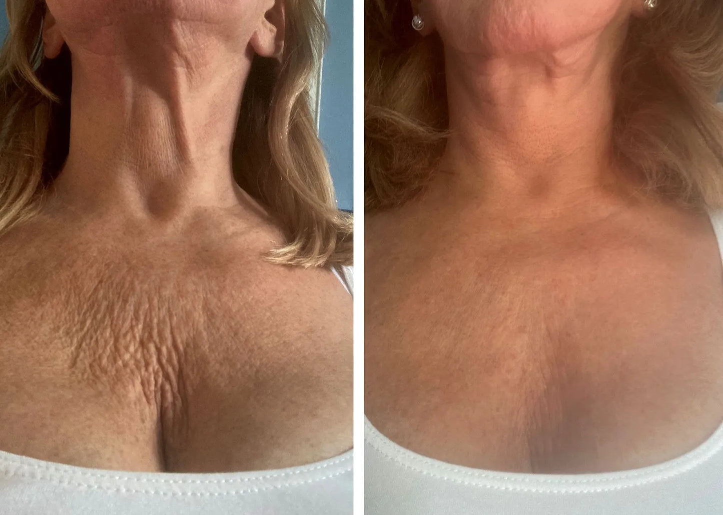 Velora Beauty® - Silicone Wrinkle & Scar Sheets