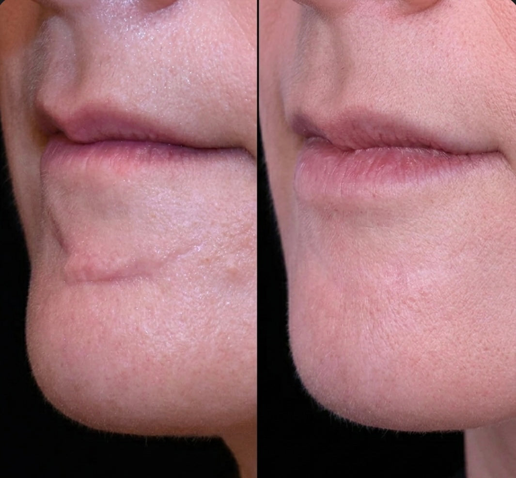 Velora Beauty® - Silicone Wrinkle & Scar Sheets